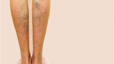 كيفية التخلص من دوالي الساقين بالمنزل