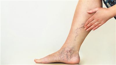  10 نصائح تساعد في علاج الدوالي