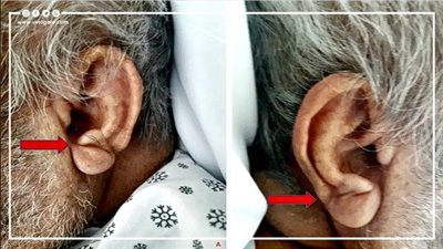 جمال شعبان يحذر أصحاب الخط المايل في شحمة الأذن، قلبك في خطر واتبع هذه النصائح 