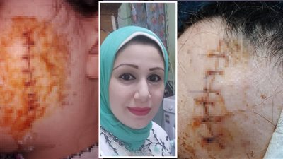 قصوا شعرها وشوهوا وجهها بـ 14 غرزة، أسرة مريض نفسي تتفنن في تعذيب زوجته من أجل الميراث بالدقهلية (صور)