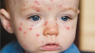 أعراض الجديري وطرق العلاج، منتشر بين الأطفال فى المدارس