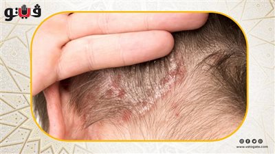 3 علامات لو ظهرت في فروة رأسك عليك الذهاب فورًا للطبيب (فيديو)
