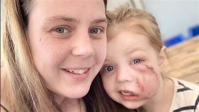 طفلة بريطانية تتلقى 40 غرزة في وجهها بعد هجوم شرس من كلب