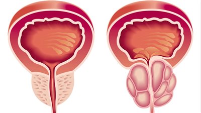 اكتشف أعراض التهاب البروستاتا.. وأفضل طرق العلاج