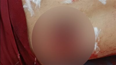 مقتل طفل إثر إصابته بطلقة خرطوش 