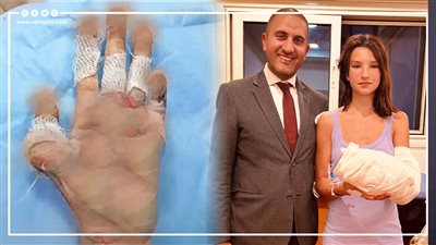 إنجاز عالمي، طبيب مصري ينقذ سائحة روسية من بتر يدها (فيديو)