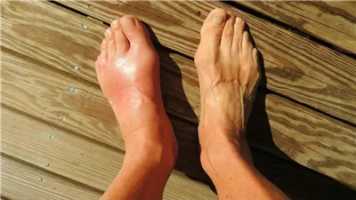 علاج النقرس، بمقاطعة اللحوم الحمراء والأسماك المملحة