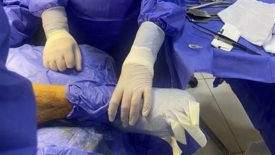 نجاح جراحة لشاب مصاب بتفتت عظام الفخذ في مستشفى أبوحماد