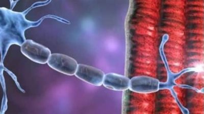 طبيبة: 10% من حالات التصلب الجانبي الضموري تكون موروثة