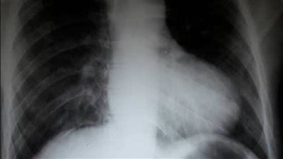 رباعية فالو، 4 عيوب خلقية في القلب تظهر عند الولادة