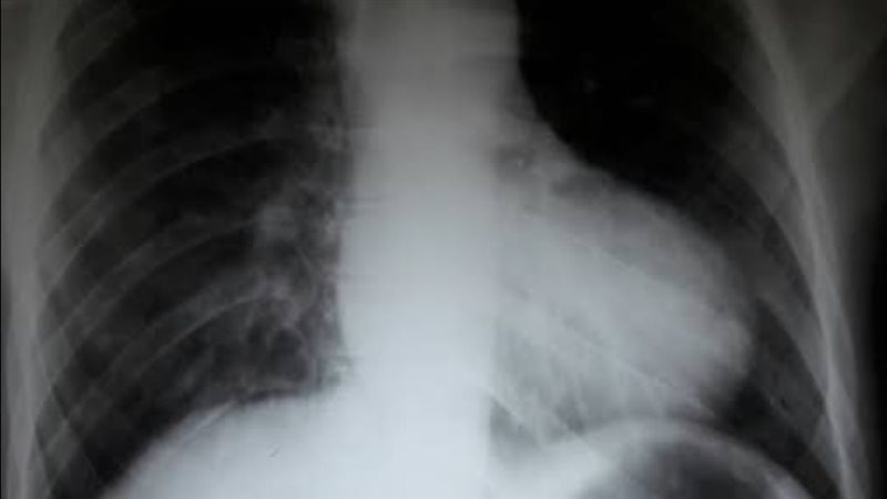 رباعية فالو، فيتو