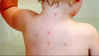 أعراض الجدري، احذري منتشر بين الأطفال في وقتنا الحالي 