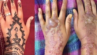 مركز السموم بعين شمس يحذر من استخدام الحنة السوداء