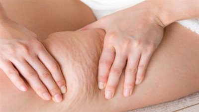 أهمها الموز والليمون، أكلات لعلاج السيلوليت في البيت