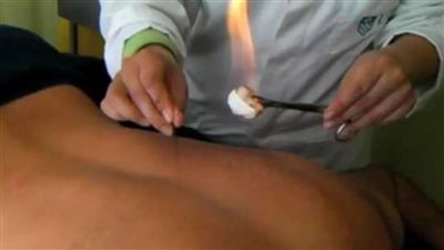   تفسير حلم الكي بالنار في المنام وعلاقته بالبخل ومنع الزكاة 