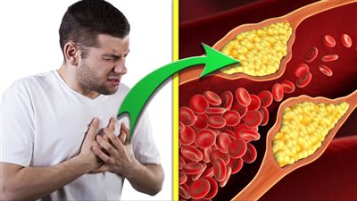 استشاري باطنة: ارتفاع الكوليسترول يسبب هذه الأمراض