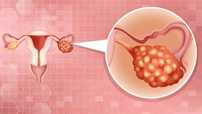 اليوم العالمي لـ سرطان المبيض، الصحة: الرياضة تقلل خطر الإصابة بنسبة 20% 