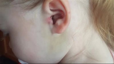 حالة من الرعب عاشتها أم بسب ما عثرت عليه في أذن ابنتها 