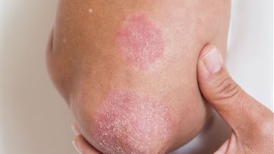 يصيب 30% من المرضى بالتهاب المفاصل الصدفي، تعرف على مضاعفات وأعراض الصدفية