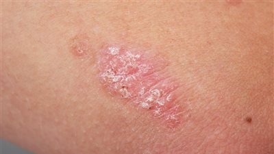 أسباب ظهور حبوب حمراء بالجسم وطرق علاجها