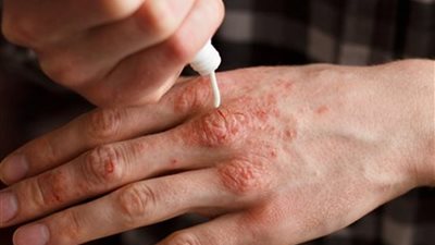 علاج الصدفية نهائيا، ومعرفة الأعراض وأسباب الإصابة