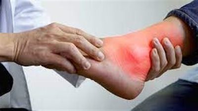 هيئة الدواء تكشف أهم أعراض مرض النقرس 