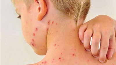  منها التهاب الرئة والدماغ، تعرف على أعراض ومضاعفات الحصبة