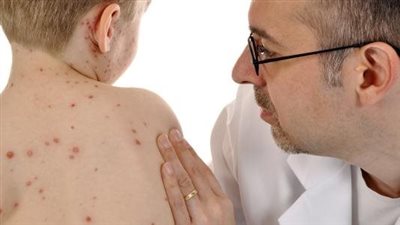 الحمى والتهاب الحلق، أهم أعراض مرض الحصبة 