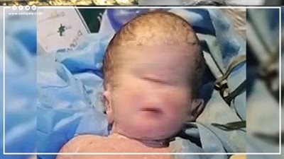 ولادة غريبة لطفل بعين واحدة في محافظة ذي قار بالعراق