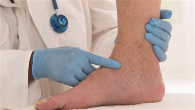 أخطرها فشل القلب وتليف الكبد، أهم أسباب تورم القدمين 