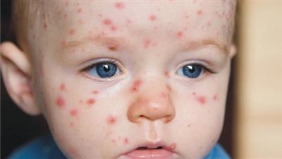 الأعراض المبكرة للجدري المائي عند الأطفال ومضاعفاته المختلفة 