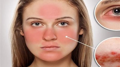  منها الصداع والطفح الجلدي، أعراض وأسباب مرض الذئبة