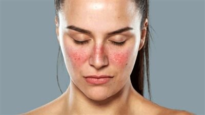 أخطرها جلطات الدم، أعراض ومضاعفات مرض الذئبة 