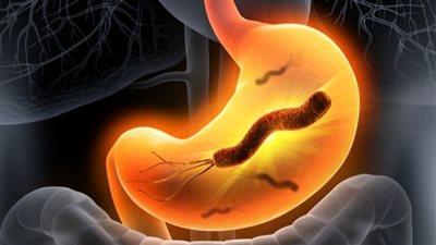 أعراض وعلاج جرثومة المعدة، ومتى تؤدي للإصابة بالسرطان؟