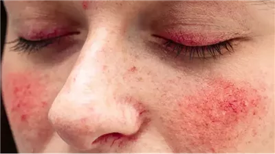 4 علامات تؤكد إصابة طفلتك بالذئبة الحمراء وأسباب الإصابة بها