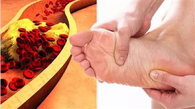 أعراض زيادة الكوليسترول، 4 علامات تؤكد إصابتك به