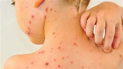 كيف تعتني بطفلك المصاب بجدري الماء
