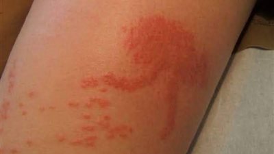 دليلك الشامل للوقاية من لسعات قناديل البحر في المناطق الساحلية