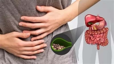 أسباب التهاب المرارة، متى يلجأ الطبيب لإجراء عملية الاستئصال (فيديو)