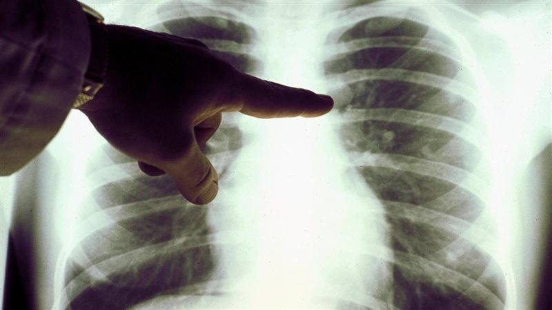 اعراض سرطان الرئة،