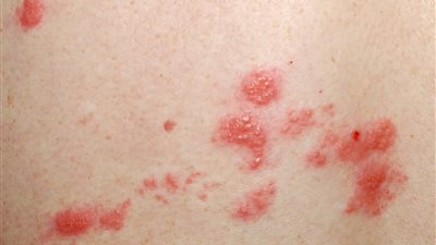 طرق علاج الحزام الناري 