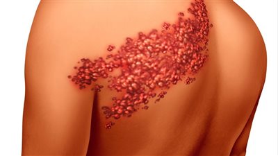 أعراض الحزام الناري لاكتشافه مبكرا وطرق العلاج 