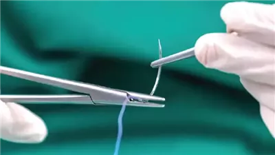 وداعا لعذاب الطريقة التقليدية، ابتكار خيوط جراحية قابلة للذوبان