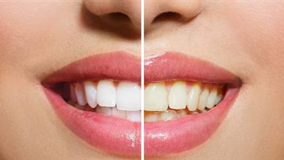  أسباب اصفرار الأسنان وطرق علاجها 