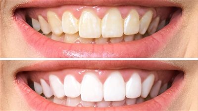 أسباب اصفرار الأسنان وطرق الوقاية منها