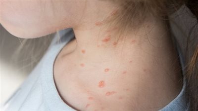 أعراض الجدري المائي، اعزلي طفلك عن إخوته فور ظهورها