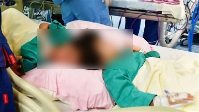 فريق طبي سعودي ينجح في فصل رأس التوأم السيامي المصري (صور)