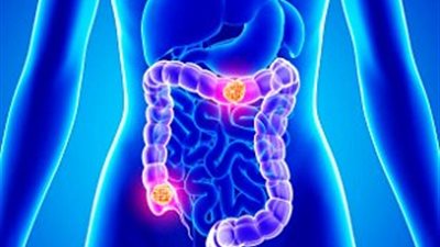 علامات مهمة مؤشر للإصابة بسرطان القولون، لا تتجاهلها