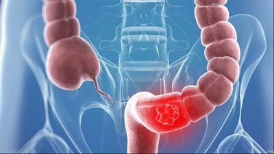 سرطان القولون، 4 فئات معرضة للإصابة بالمرض