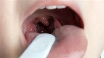 علاج التهاب الحلق، بالأعشاب الطبيعية وفي وقت قياسي